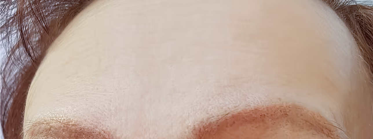 Forehead with surgical scar or suture line